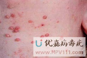 ��ͯ��Ⱦ������֢״