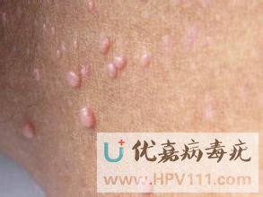 ��Ⱦ��������ʲôҩ