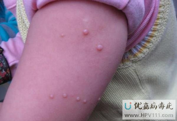 ��ͯ��Ⱦ������ƫ��