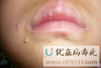 ��Ⱦ������֢״���������