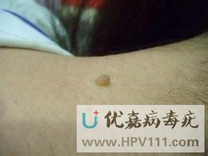 丝状疣是什么病
