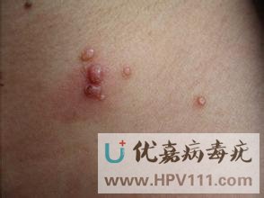 ��Ⱦ������Ϳʲôҩ