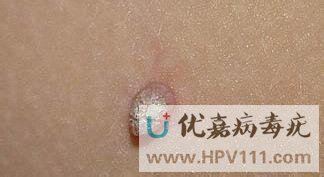 皮赘还是丝状疣