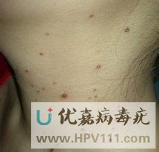 丝状疣图片大全
