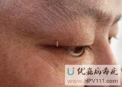 丝状疣图片大全