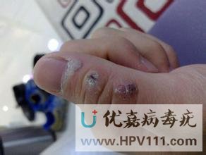 寻常疣冷冻后图片