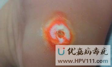 跖疣和鸡眼的区别
