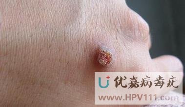 寻常疣的种类及图片