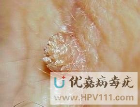 寻常疣的种类及图片