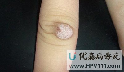 寻常疣的特点是哪些