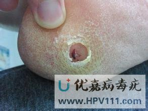 寻常疣的特点是哪些