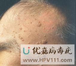 怎样科学预防扁平疣