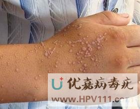 怎样科学预防扁平疣