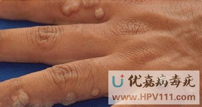 寻常疣产生原因是什么