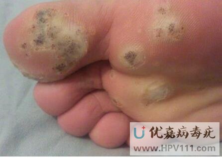 跖疣怎么样才是好转