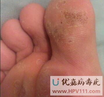 跖疣怎么样才是好转